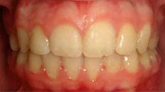 Closeup of teeth after bite correction