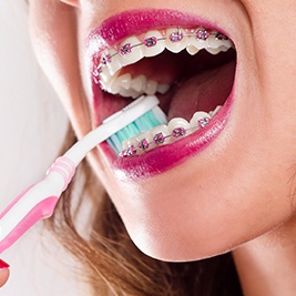 Closeup of teeth brushing with braces