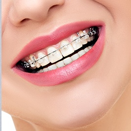 Closeup of teeth with clear braces