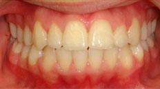 Closeup teeth after treatment with braces