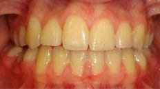 Closeup of properly aligned teeth