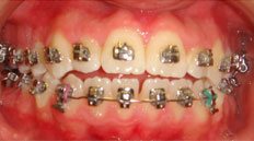 Closeup teeth with metal braces