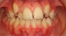 Closeup of misaligned teeth