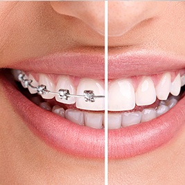 Closeup of teeth half before half after braces