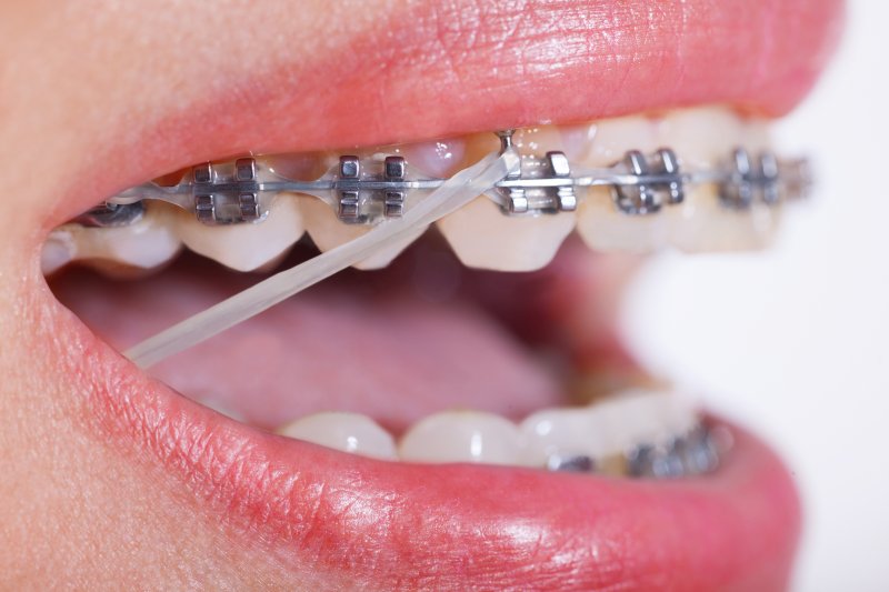 Which Orthodontic Treatment is Right for Me? - Auburn Dentist