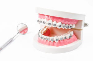 braces on dental model