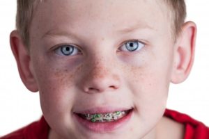 Boy smiling with braces in red shirt