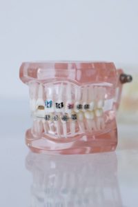 Braces on dental model