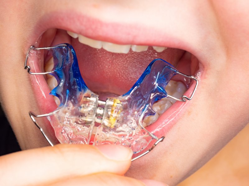 up-close view of a removable retainer